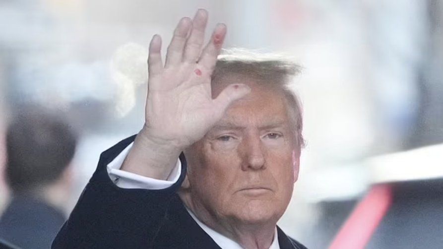 Krev, modřiny a škrábance. Trump se přiznal, že ignoruje doporučení lékařů